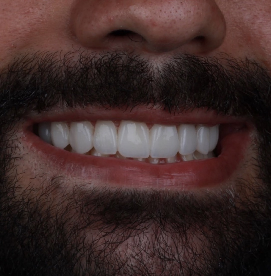 Caso real de lente de contato dental