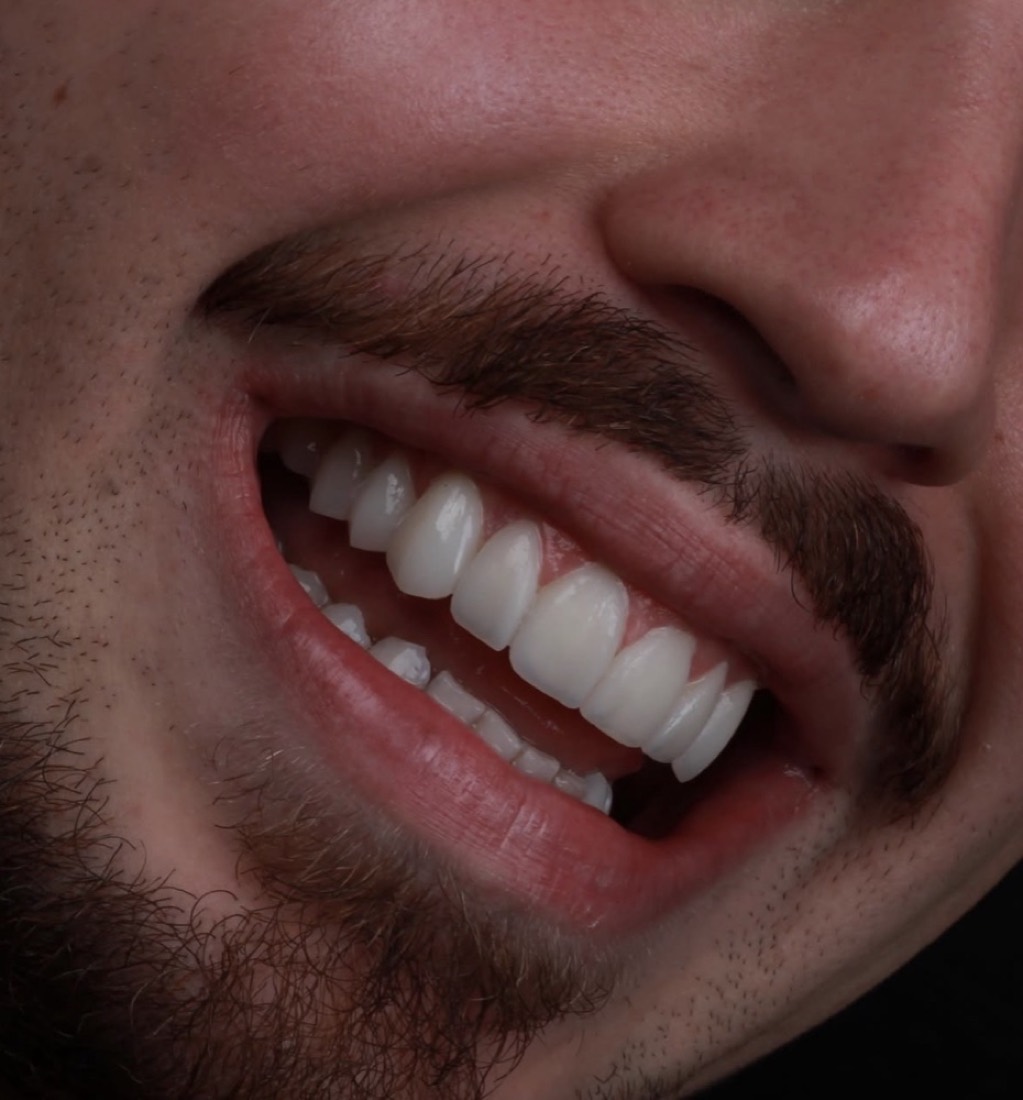 Caso real de lente de contato dental